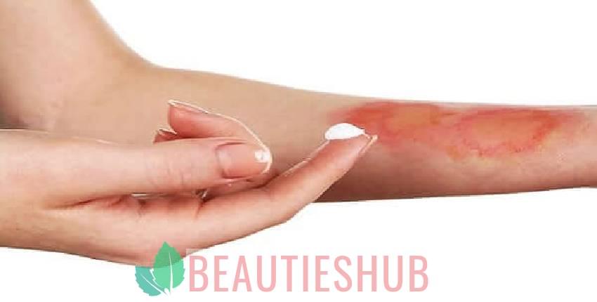 طرق علاج الحروق